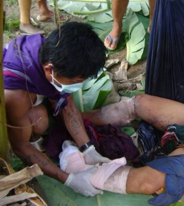 Landmine injury