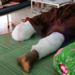 Returning Displaced Mae Tha Wor Villager Loses Lower Leg in Landmine Explosion – Villagers Fear Mines Used by the BGF and DKBA Militias